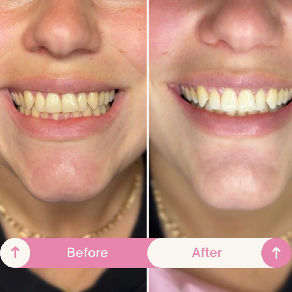 Teeth Whitening at The Lash Queen in Glen Cove, NY