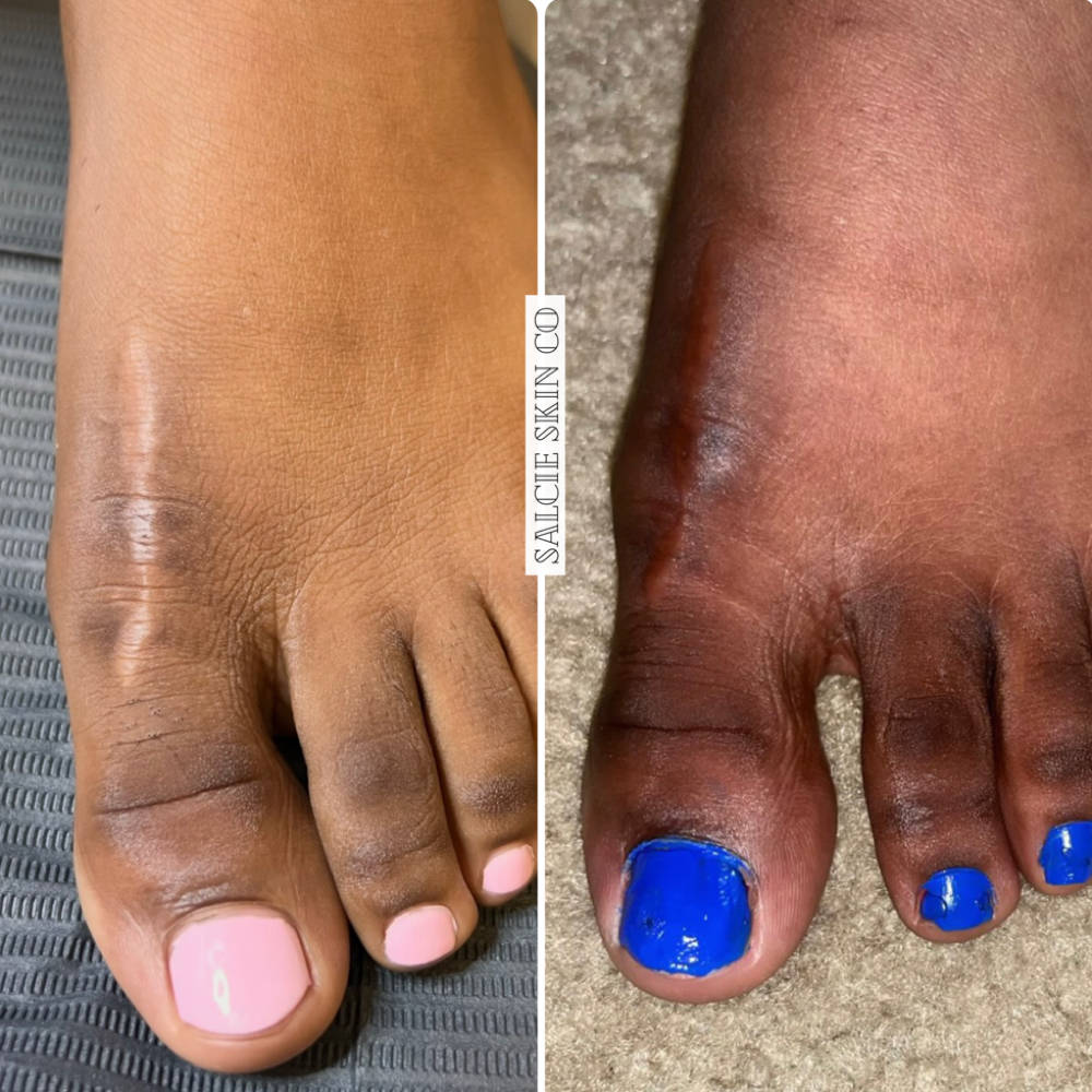 Scar Resurfacing at SALCIE SKIN COMPANY in Raleigh, NC