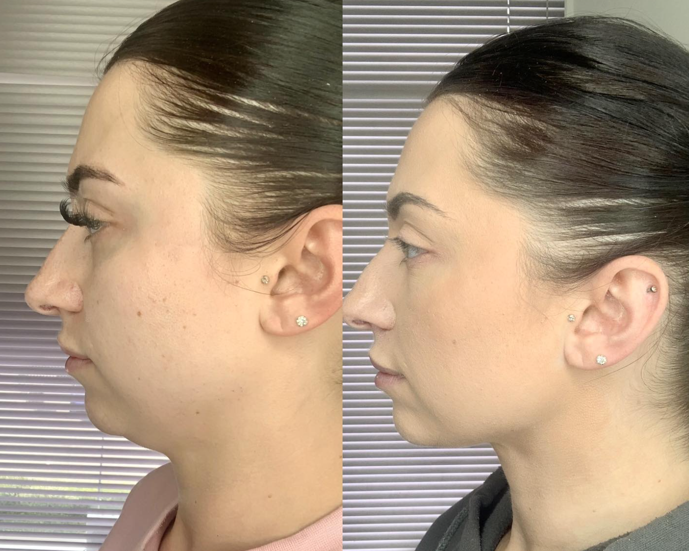 Cheek Contour - Lipo Dissolve