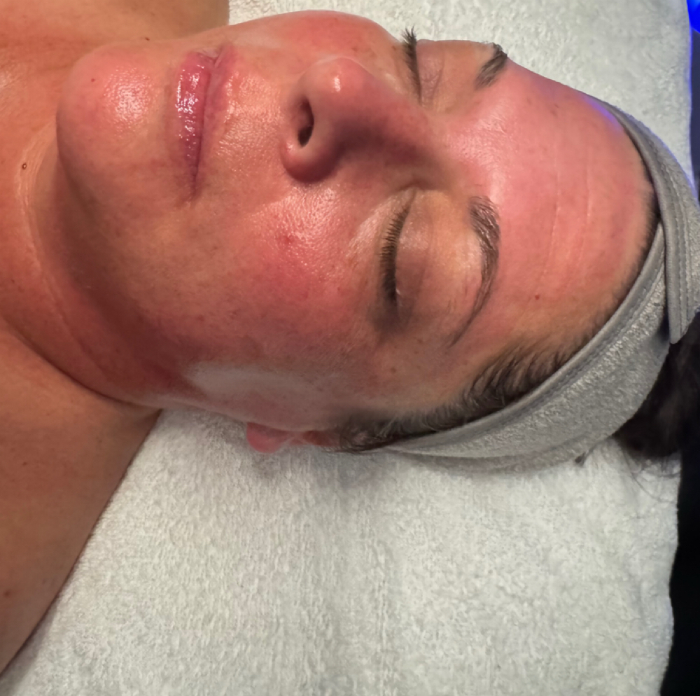 Mirco Needling at Lane Luxury Esthetics in Bartlesville, OK