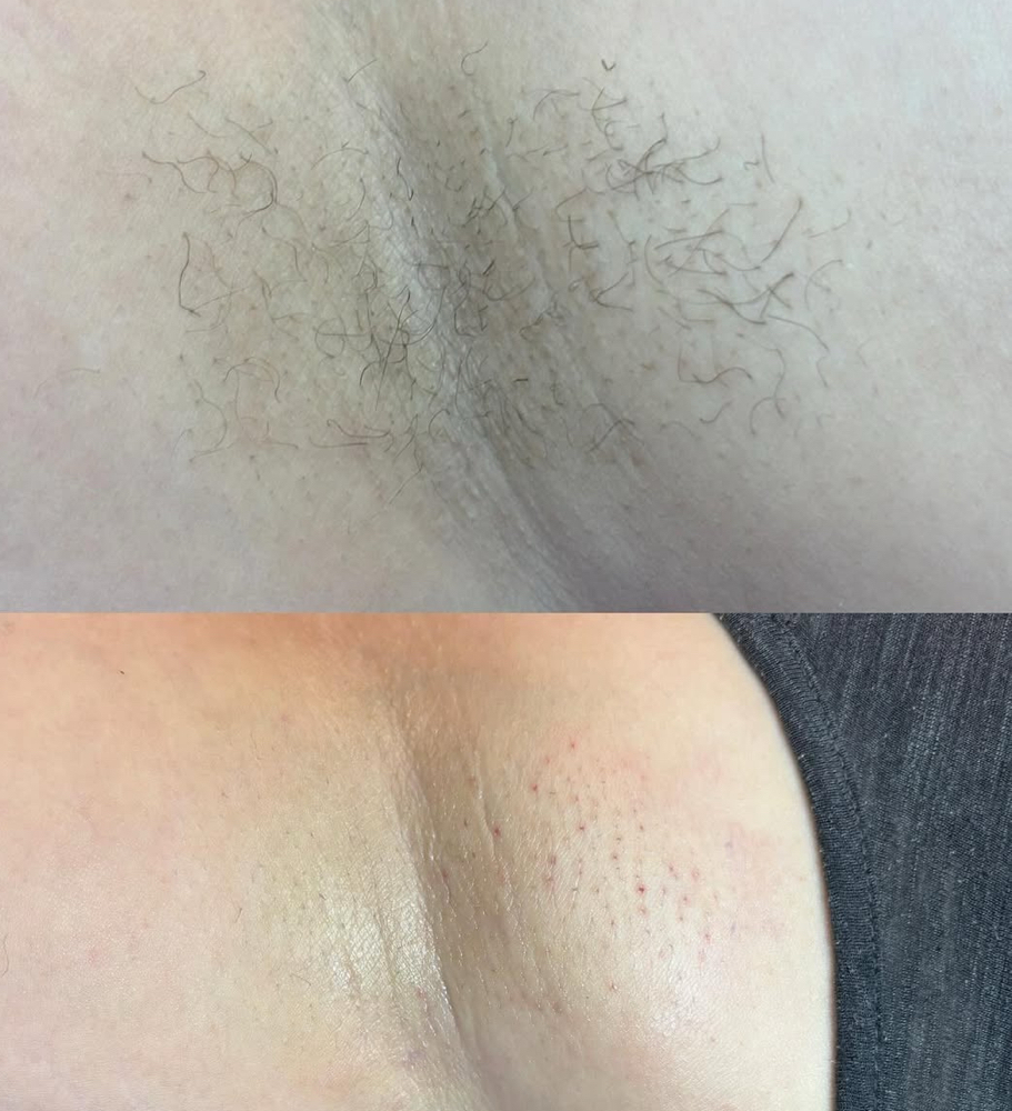 Underarm Wax