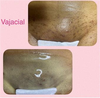 ✨Deluxe Bikini Full at EverSmooth Waxing in Tulsa, OK
