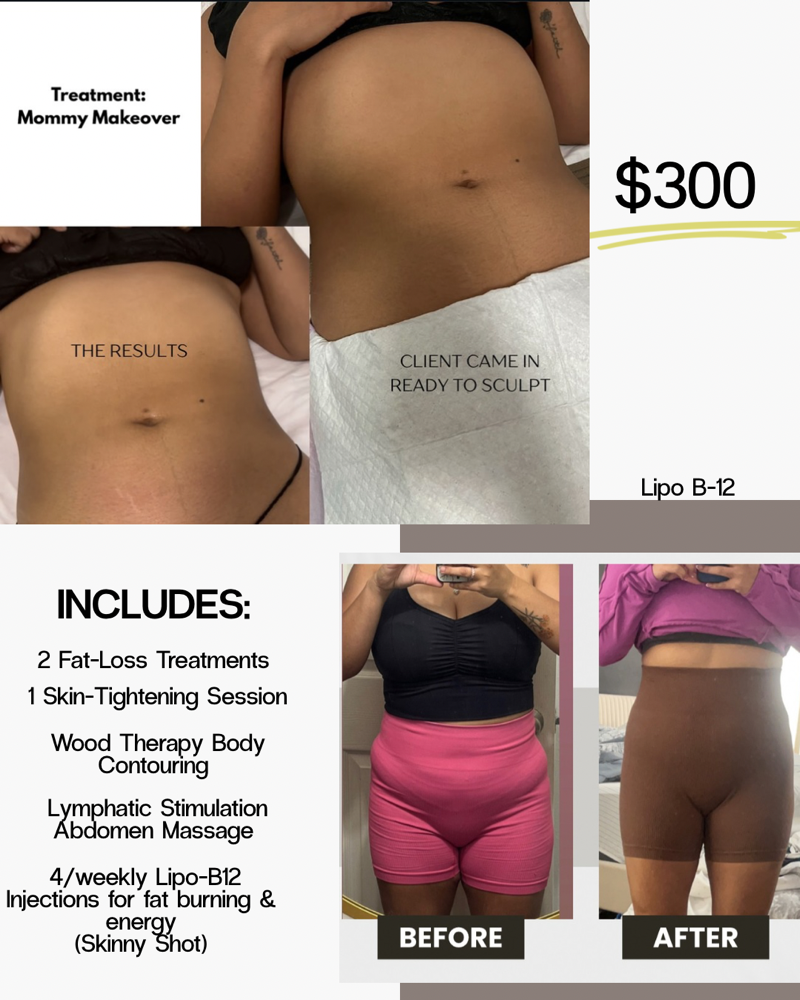 Mommy Makeover Sculpting Package at TRES Aesthetics in Missouri, TX