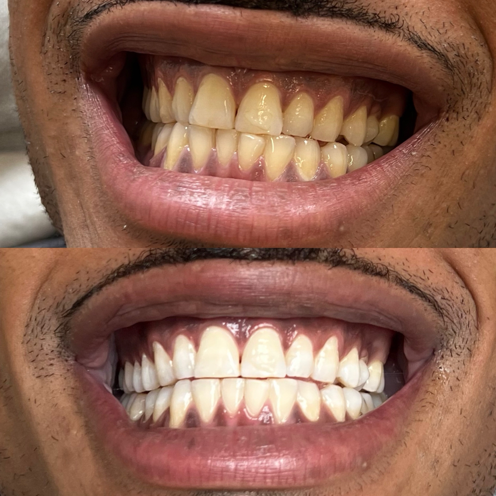 (3) Teeth Whitening Bundle