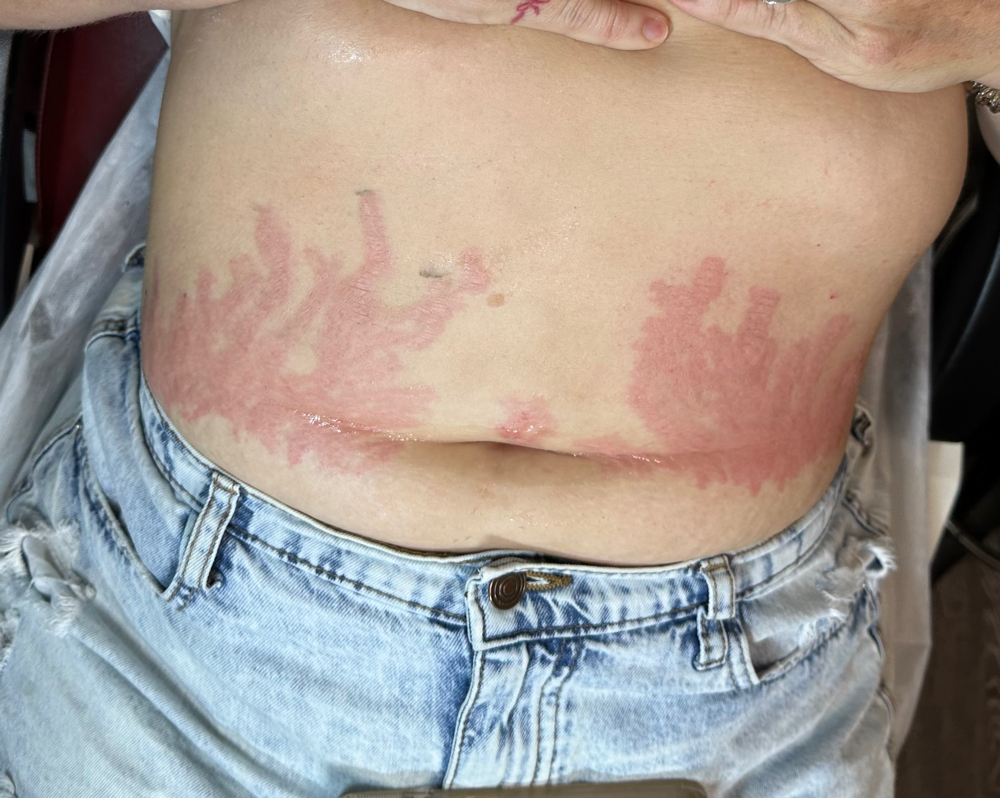 Stretch mark: Full Abdomen Or Back