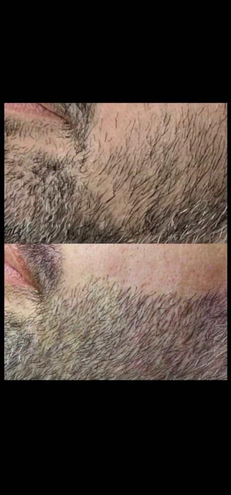 Mustache/Beard Tattoo Hair Density