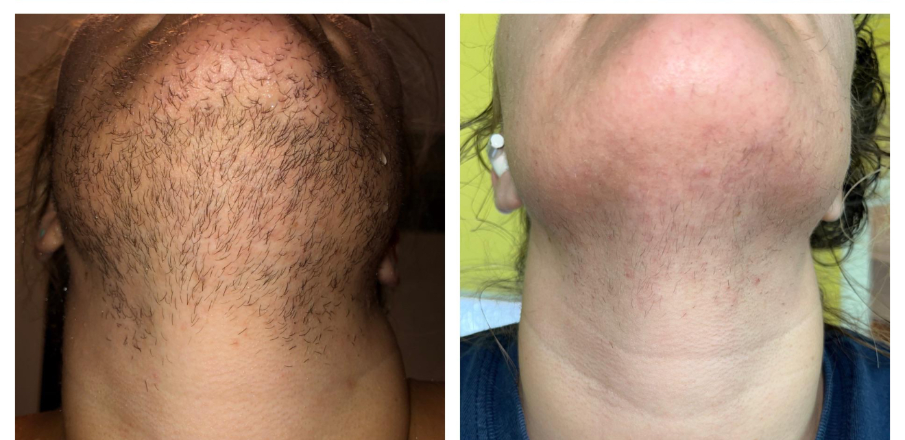 ELECTROLYSIS PERMANENT HAIR REMOVAL at Slaykwin in San Diego, CA