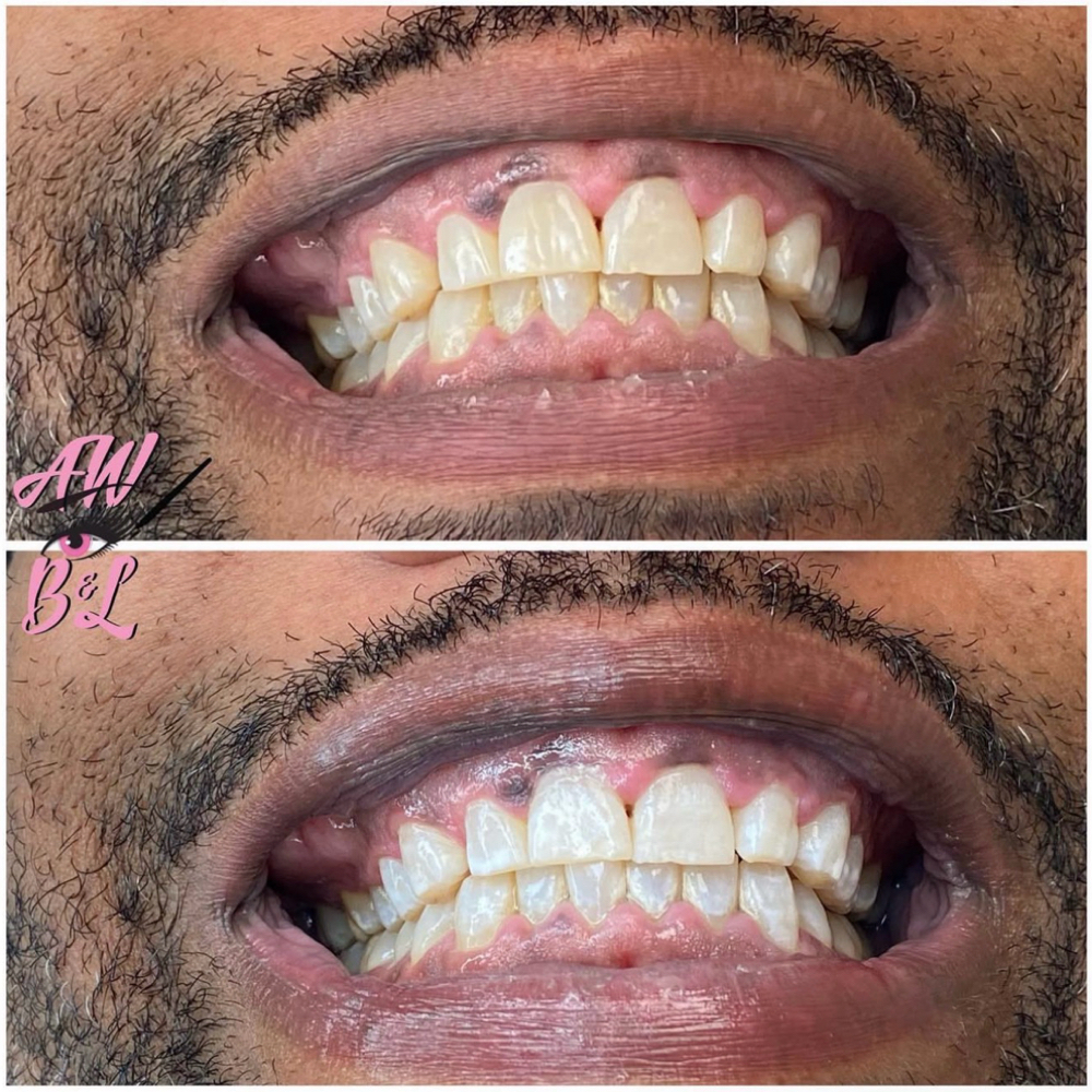 Teeth Whitening at A.W. Brows & Lashes in Las Vegas, NV
