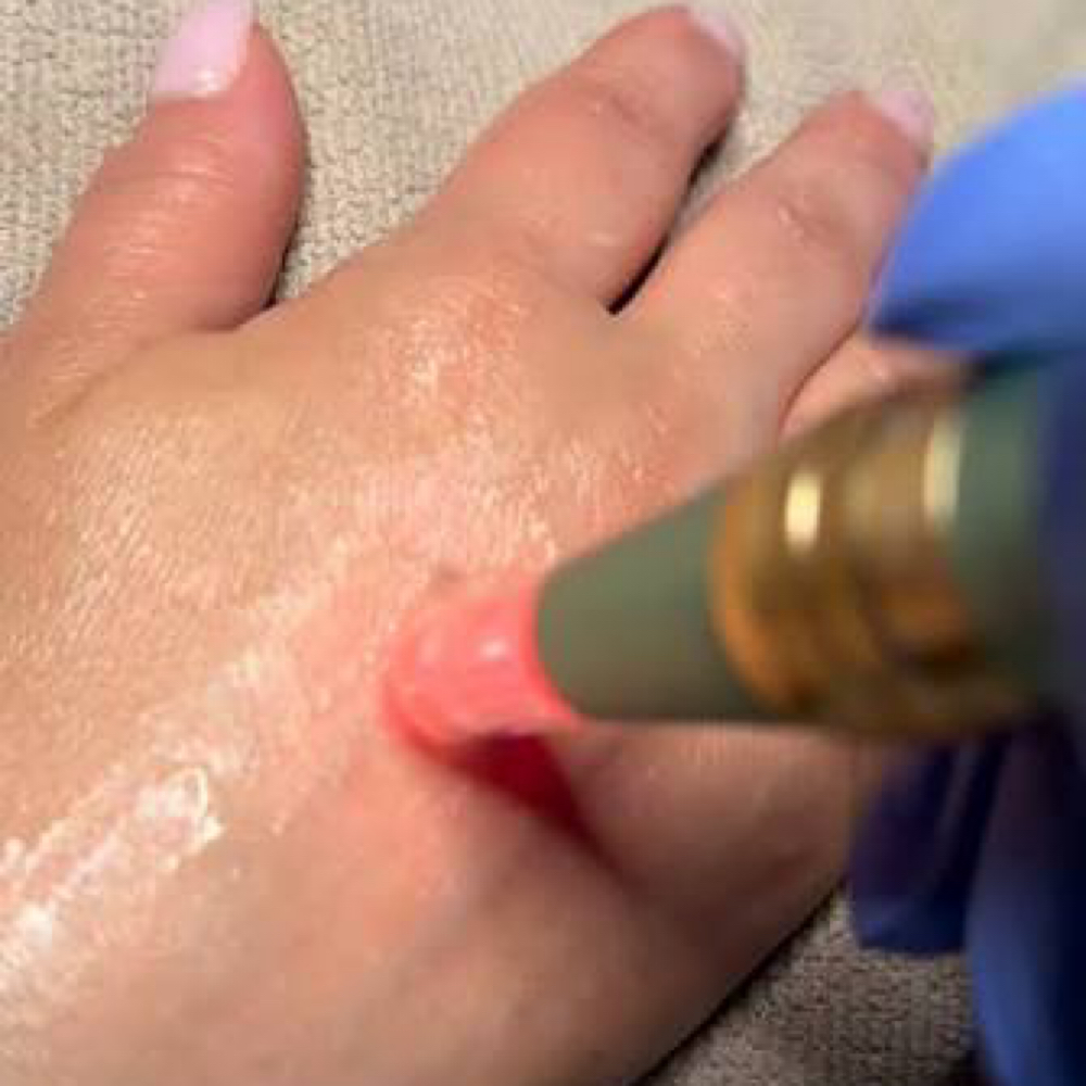 Microneedle - Hands at Luminous Aesthetics in Fayetteville, AR