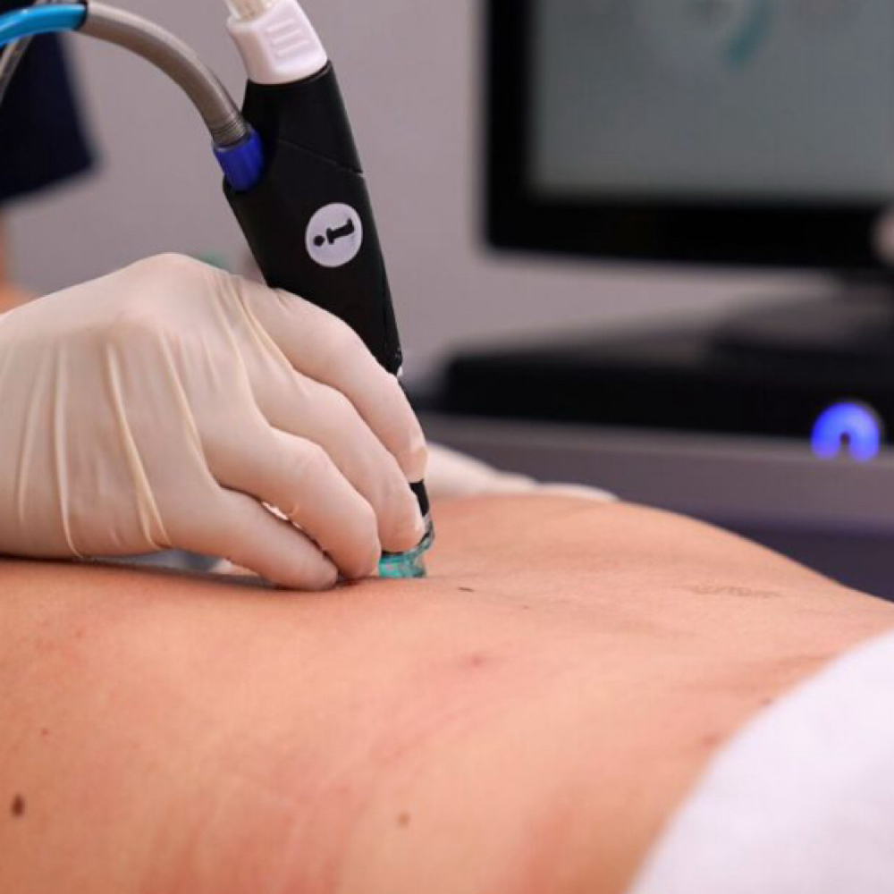 Hydrafacial- Full Back at APMU MED SPA | Atlanta Aesthetics & Permanent Makeup in Marietta, GA