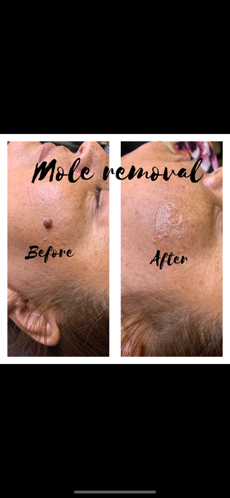 Mole Removal 1hr