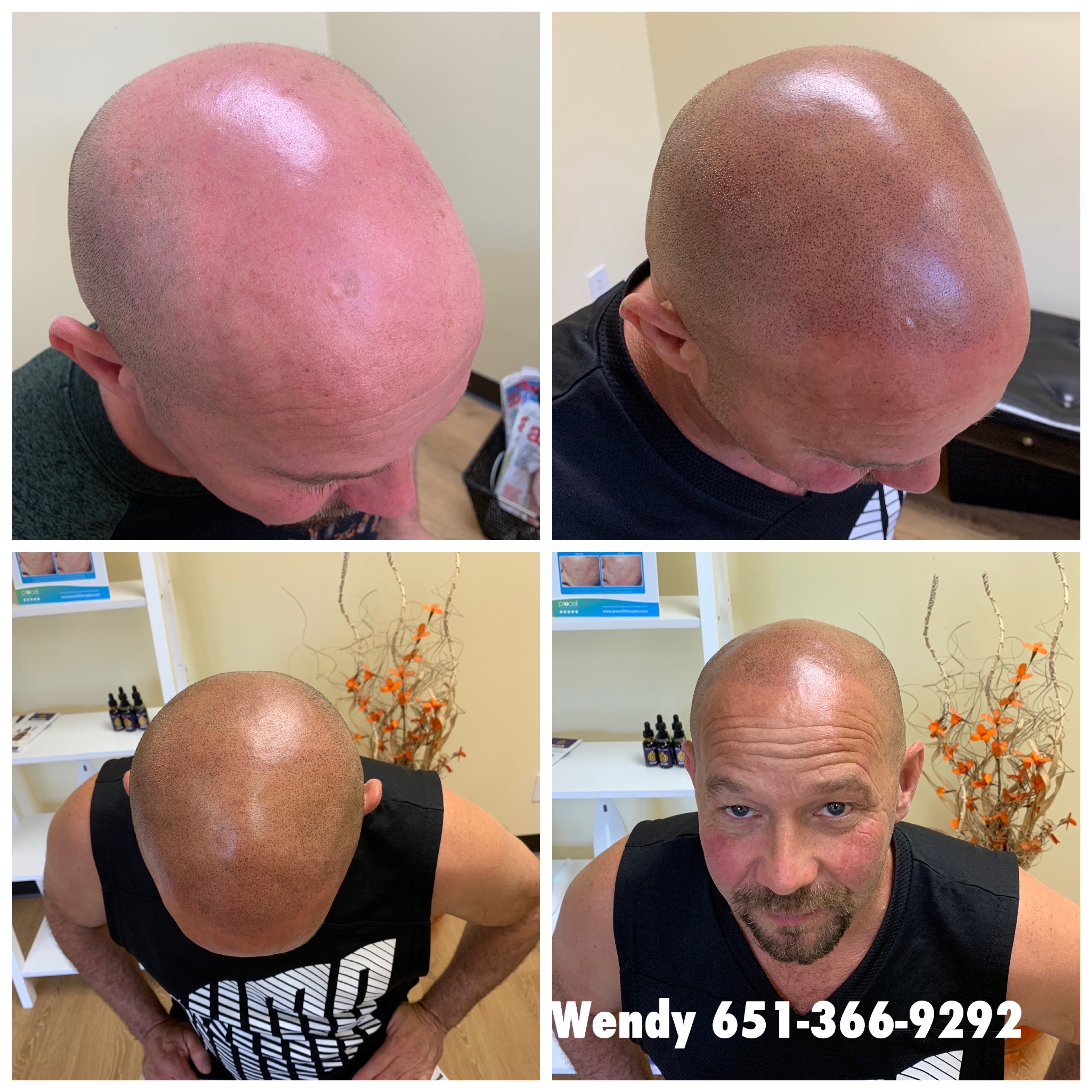 Scalp Pigmentation Permanent