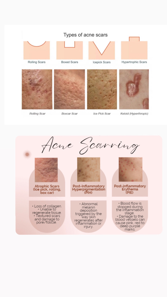 PLASMA PEN ACNE SCAR REDUCTION