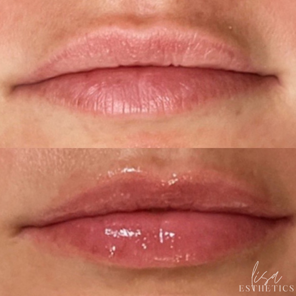 Lip Treatment Add-On