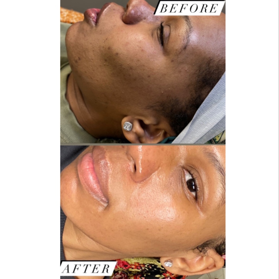 PEEL LEVEL 1 (Light Peel) at FIRMÉ SKIN in Columbia, MD
