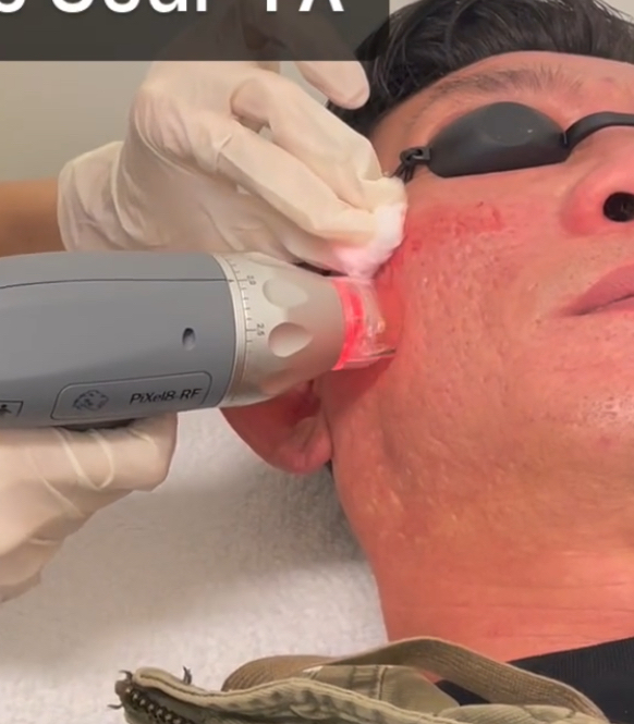 Pixel 8 RF Microneedling