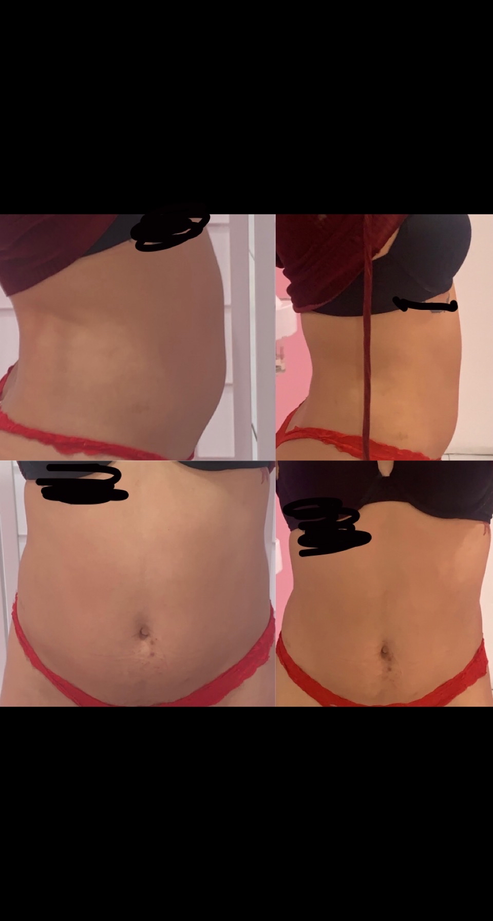 Laser Lipo