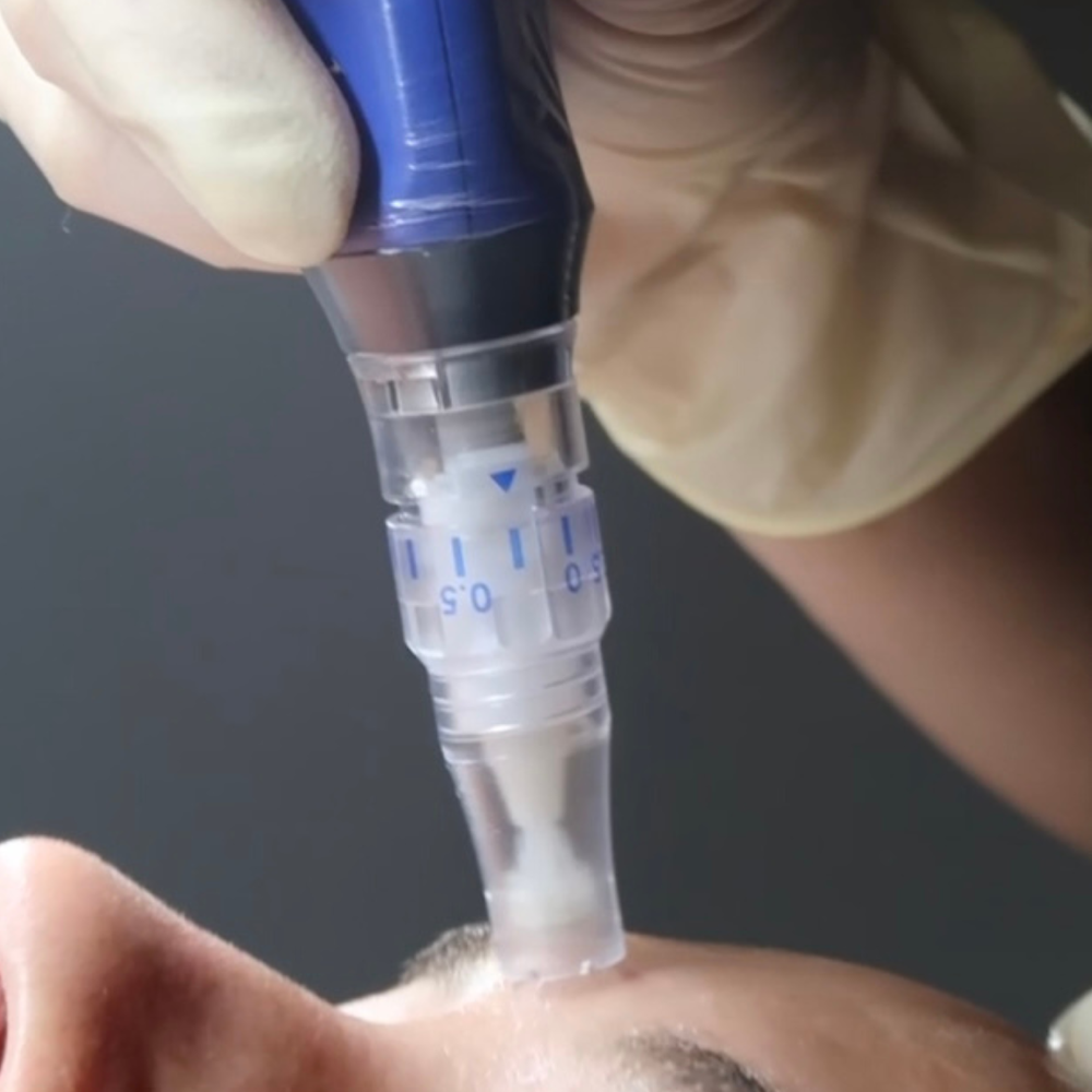 SKINPEN MICRONEEDLING