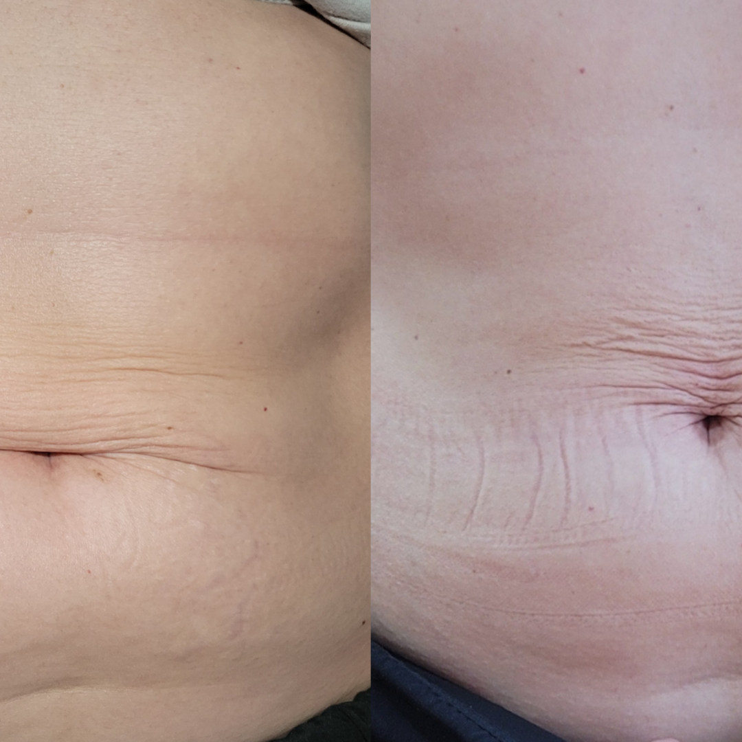 BODY CONTOURING & SCULPTING at GloVolution LLC in Homosassa, FL