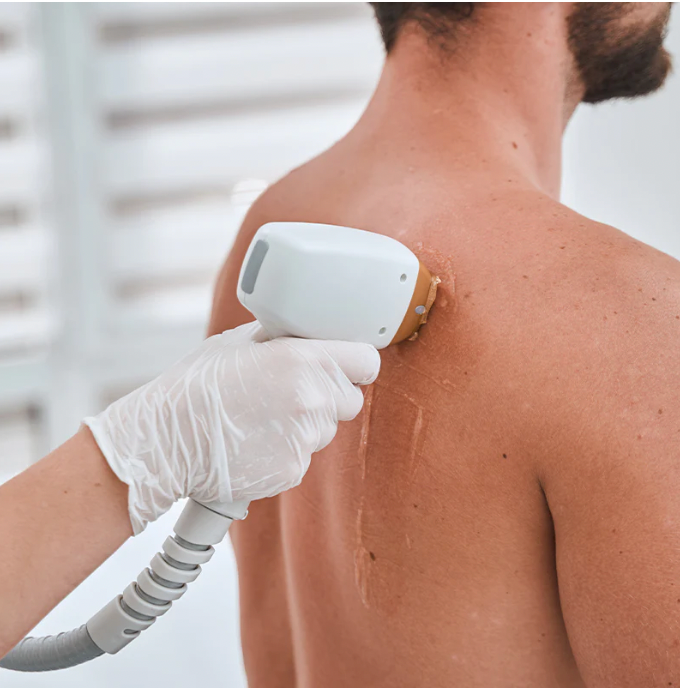 Back Laser Hair Removal