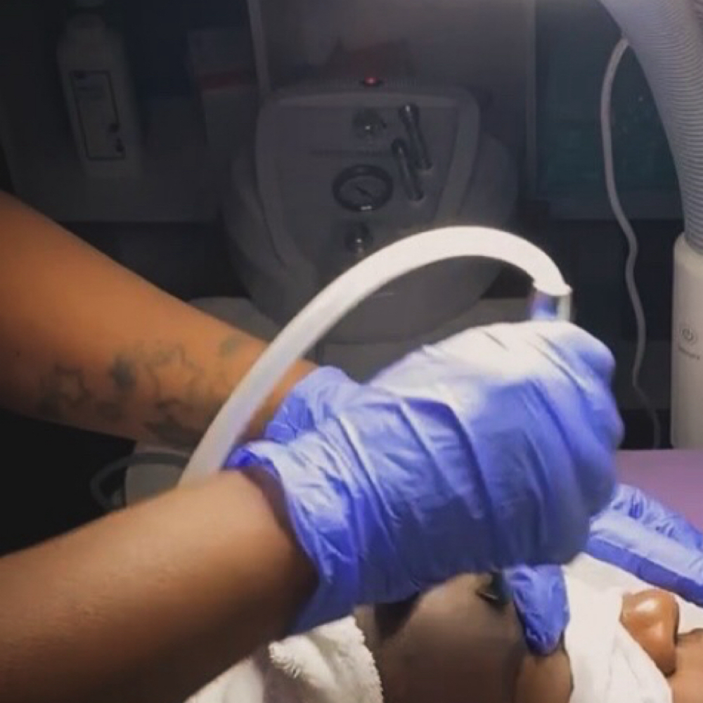 Microdermabrasion Facial at Renewed Beauty & Spa in Warner Robins, GA