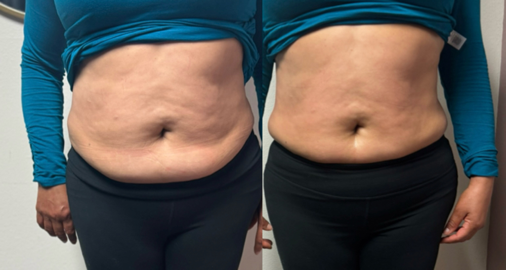 RF Body Sculpting (1 Area)