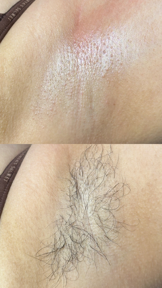 Underarms Sugaring