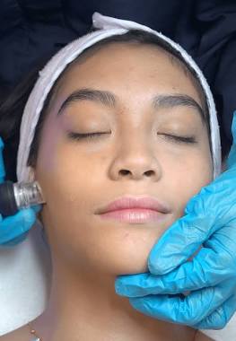 Microdermabrasion
