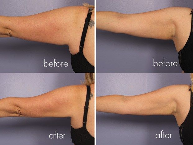 ARMS LIPO CAVITATION