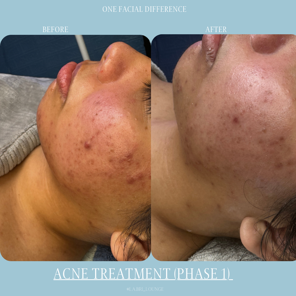 Acne Treatment (Phase 1)