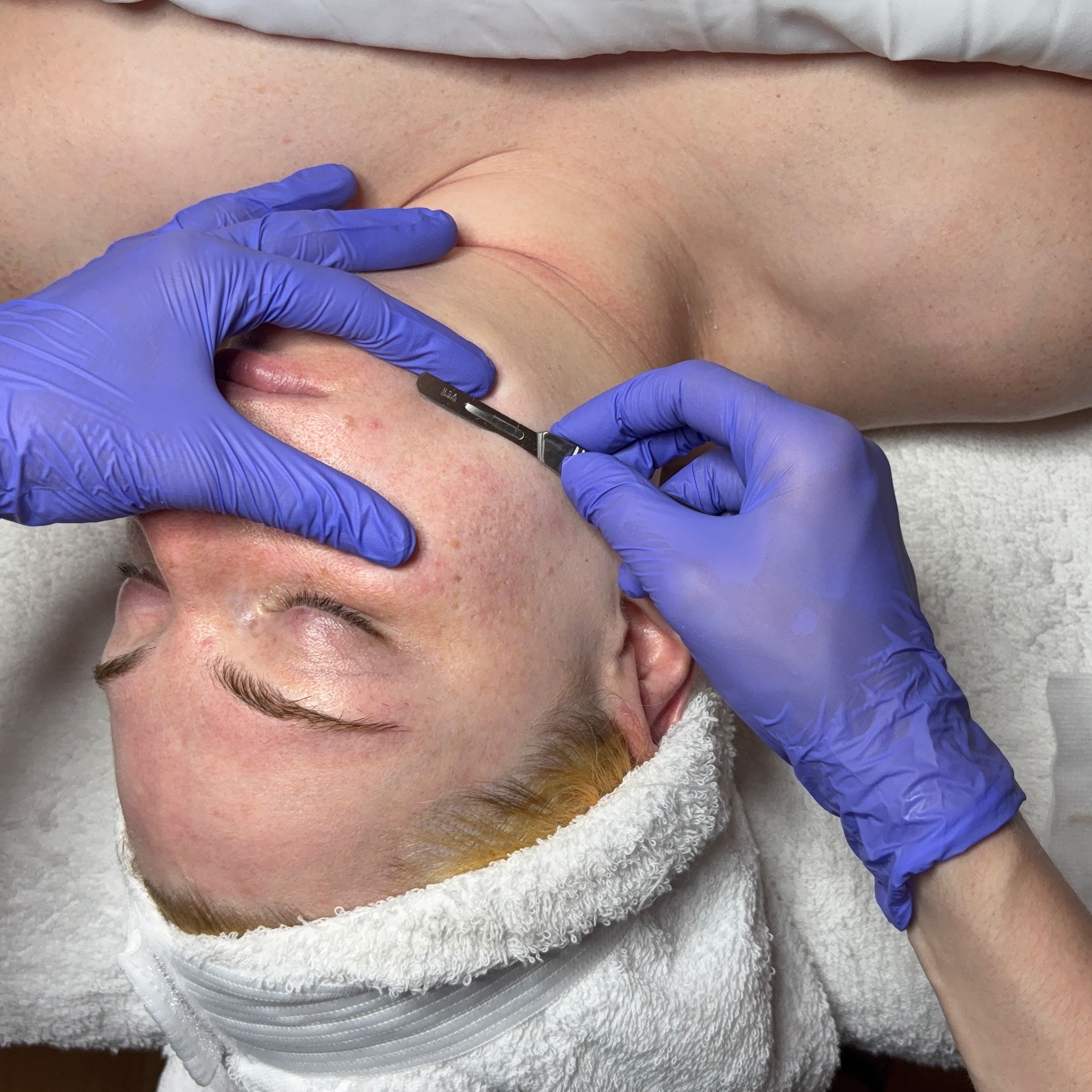 Dermaplane at Esthetics by Bella in Evanston, IL