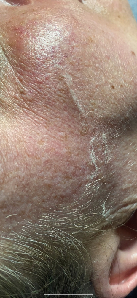 Dermaplaning Facial