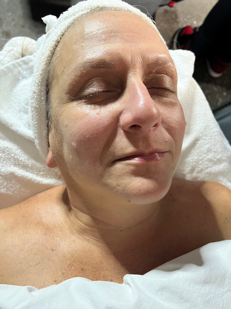 Lactic Acid Peel