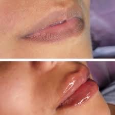 LUSCIOUS LIP FILLERS ~ .5 ML