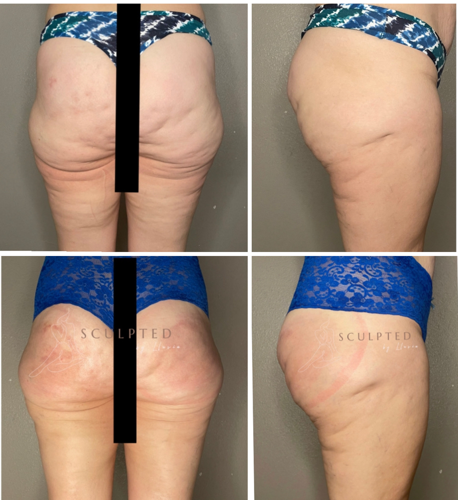 Cellulite Blaster at Sculpted by Lluvia in Weslaco, TX