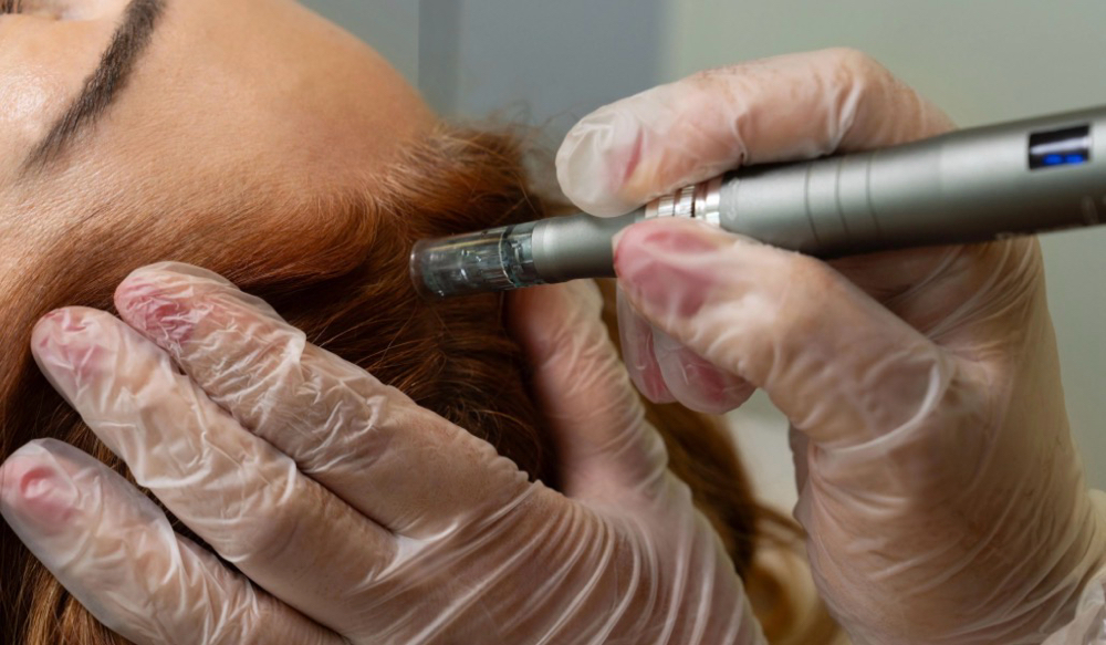 Scalp micro infusion