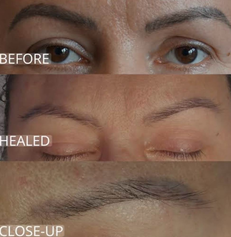 Saline Tattoo Removal – $150 per se