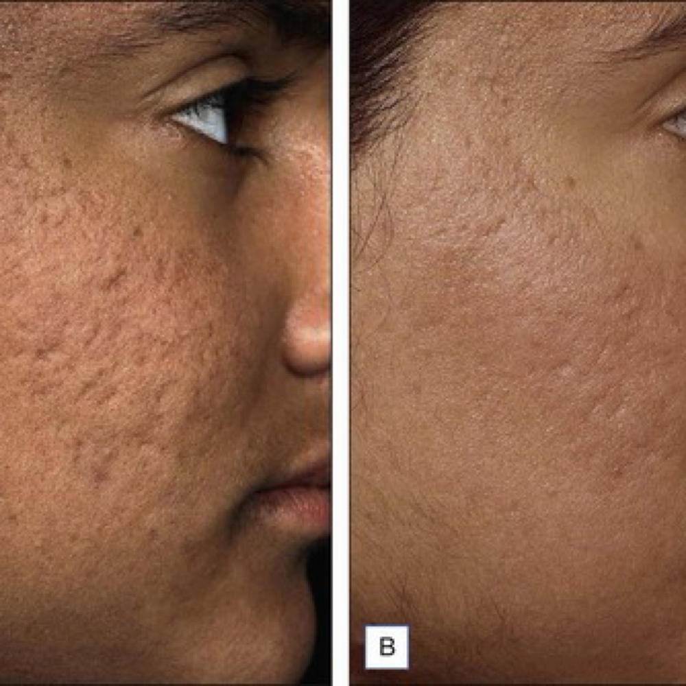 The NeoCollagenesis Facial at Desert Rose Skincare in Rio Rancho, NM