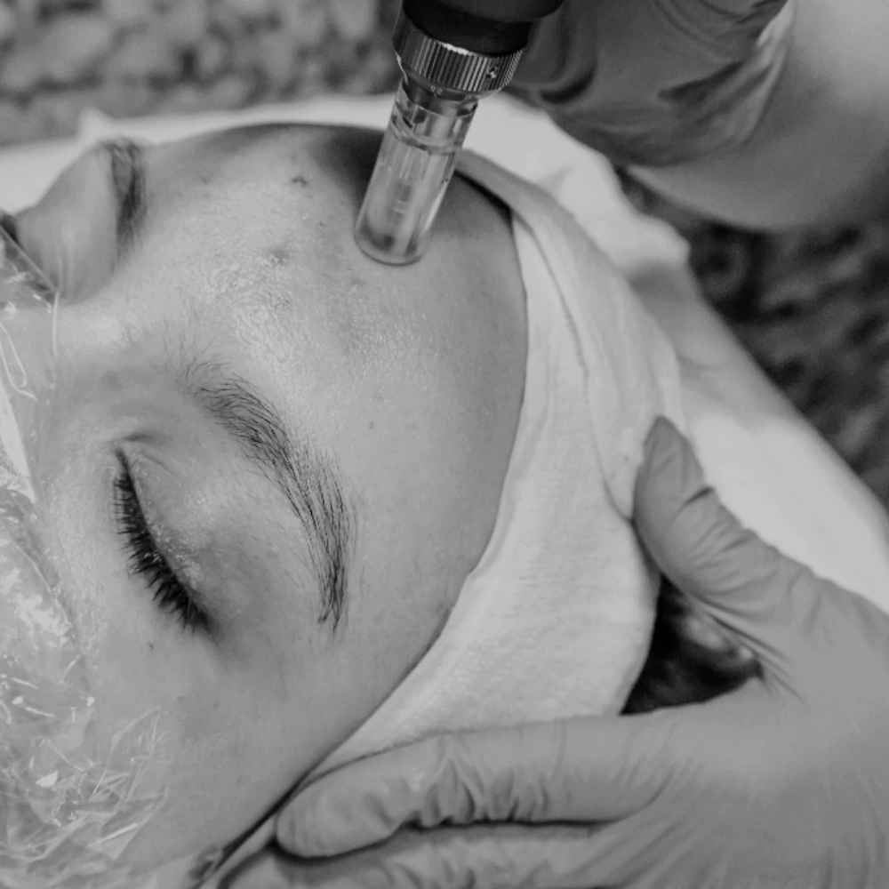 Microneedling Face & Neck at The Neon Door in Tucson, AZ