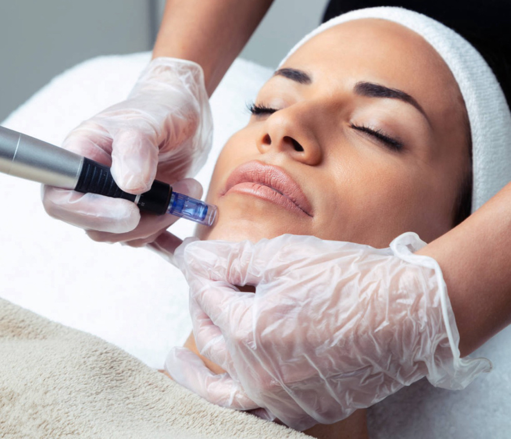 Microneedling