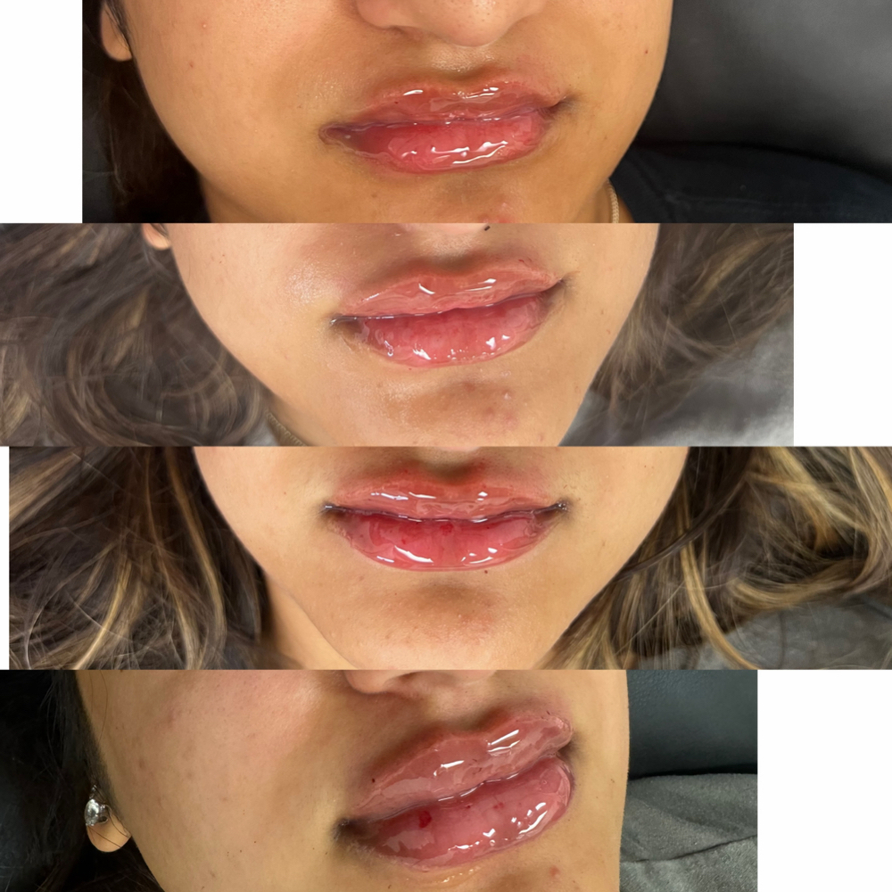 Lip Filler at Coco Luxe Spa & Suites in North Chesterfield, VA