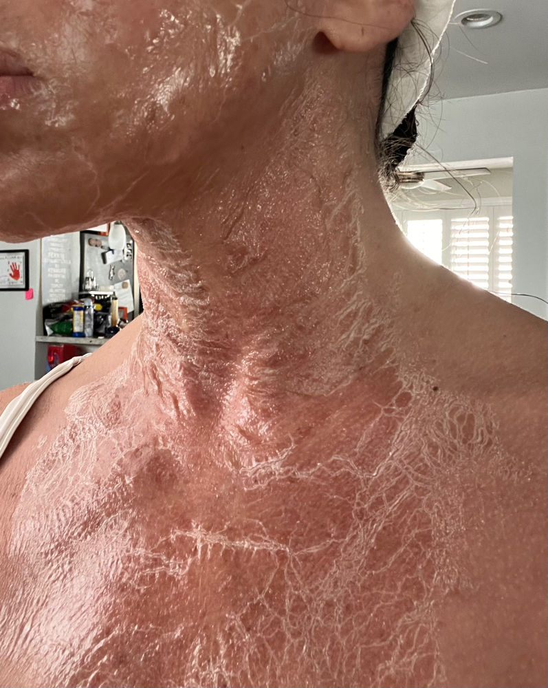 Chest Treatment