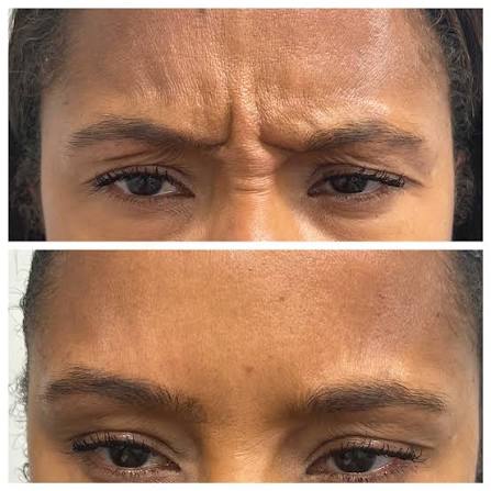 Botox - Glabella (Between Eyes) at Natural Glow in Grand Praire, TX