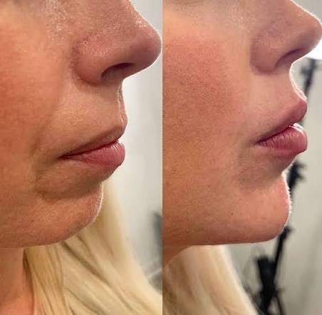 1ML Dermal Filler •CHIN• at Glam X Sam MedBeauty in Andrews, TX