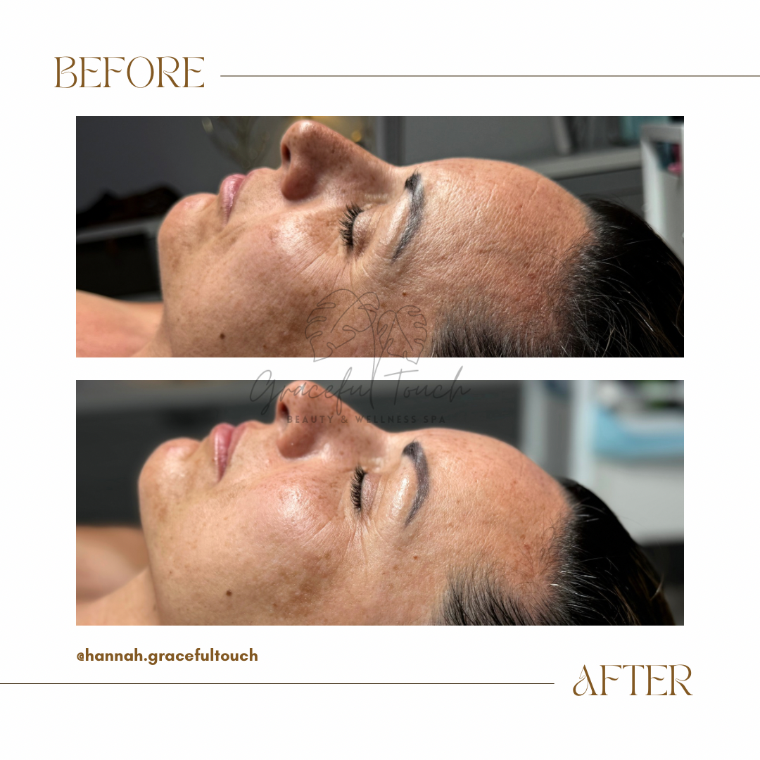 Brightening & Rejuvenating Peel