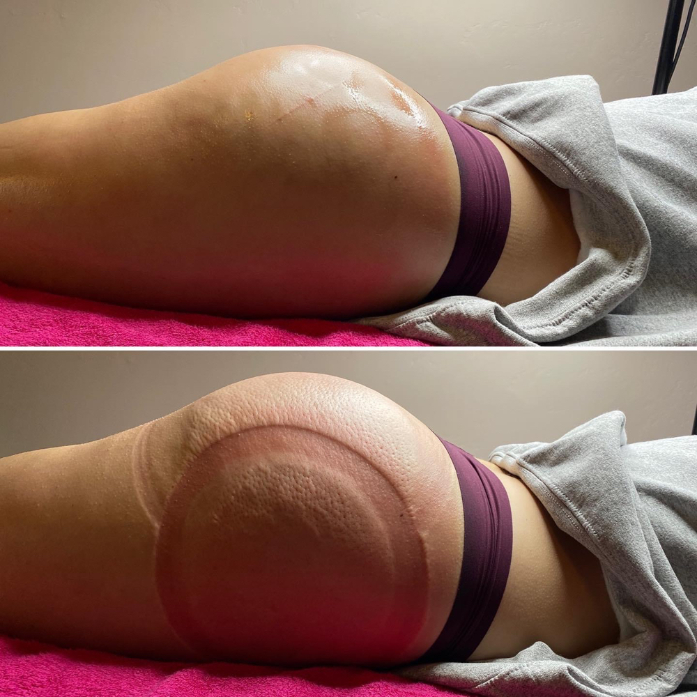 Non-Invasive BBL at Christina’s Cosmetics in Jerome, ID