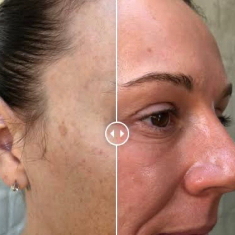 Enzyme W/ Dermaplane OR Microderm at High Life Image Skincare Studio in Tuscaloosa, AL