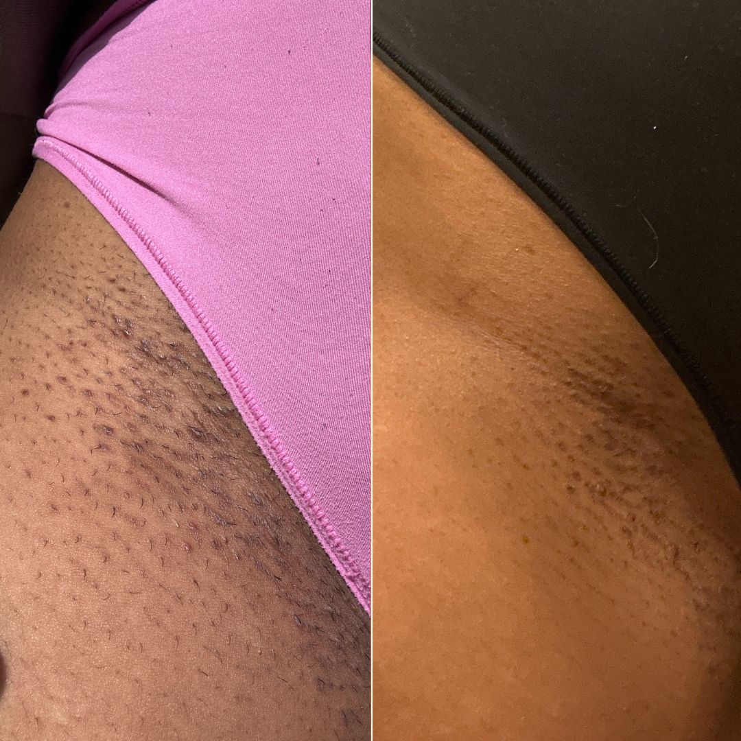 Vajacial at Unspoken Beauty Aesthetics in Port Saint Lucie, FL