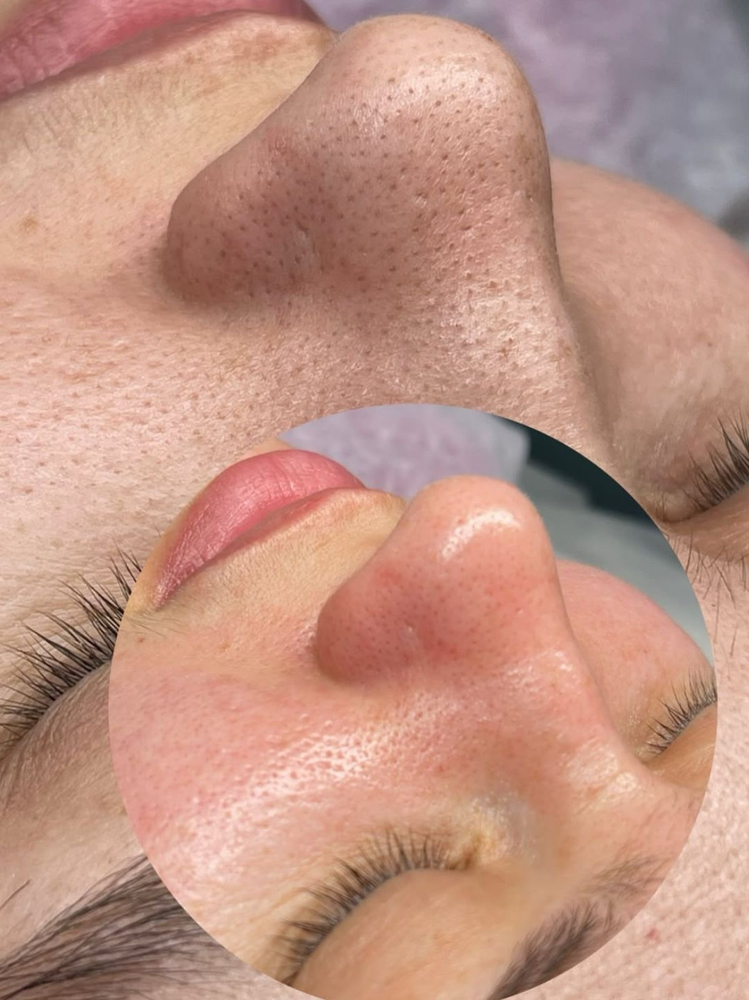 Nose Extractions HydraFacial