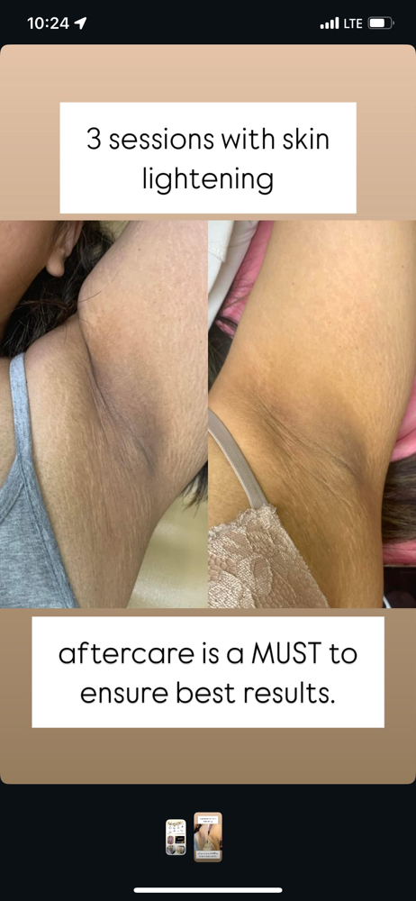 Underarms Skin Lightening